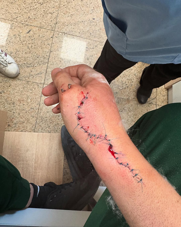 &Alpha;&nu;&delta;&rho;έ&alpha;&sigmaf; &Mu;&iota;&chi;&alpha;&eta;&lambda;ί&delta;&eta;&sigmaf; &tau;&rho;&alpha;&upsilon;&mu;&alpha;&tau;&iota;&sigma;&mu;έ&nu;&omicron; &chi;έ&rho;&iota;